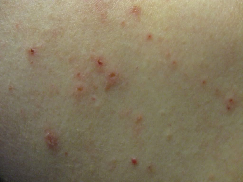 Itchy Rash Behind the Knees and Around the Elbows ...